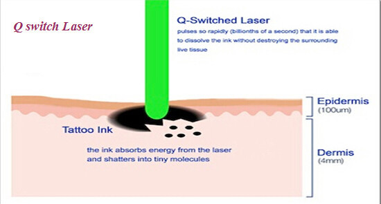 machine rapide d'épilation de laser de la vente 2014 chauds de xglaser